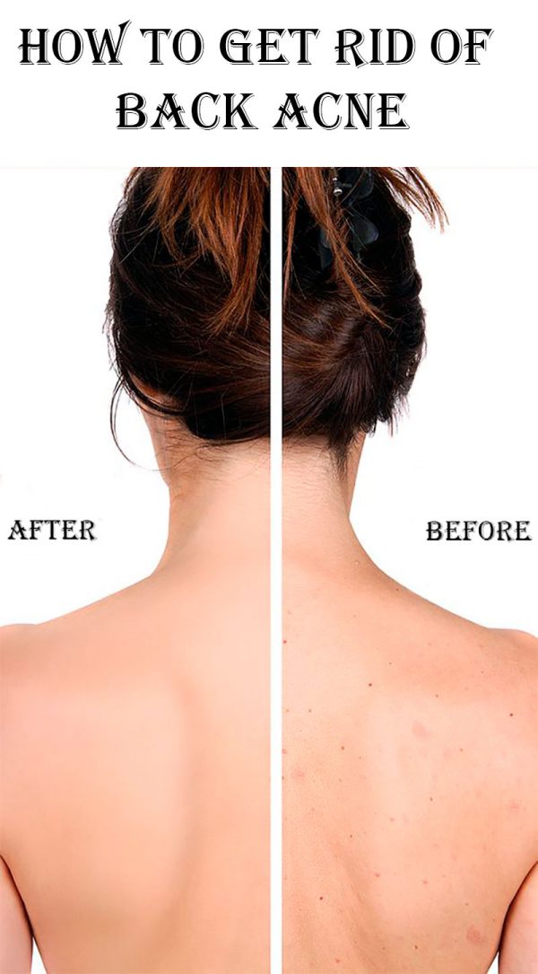 How to Get Rid of Back Acne