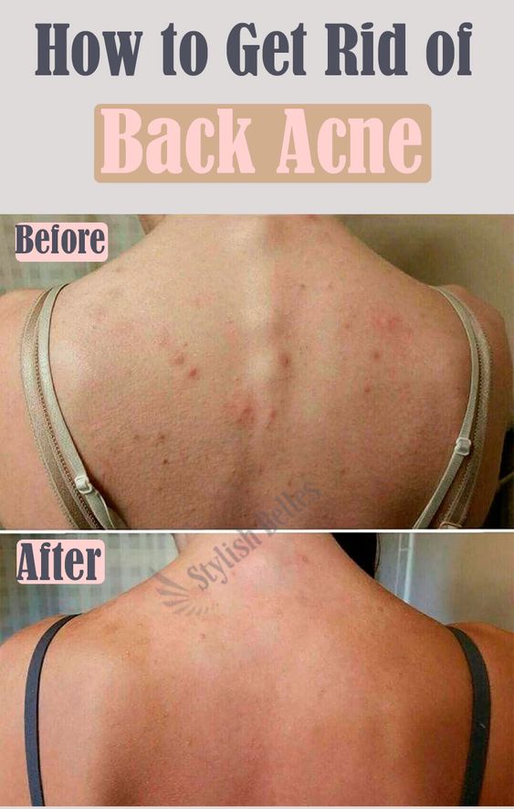 Valuable tips to get rid of back acne