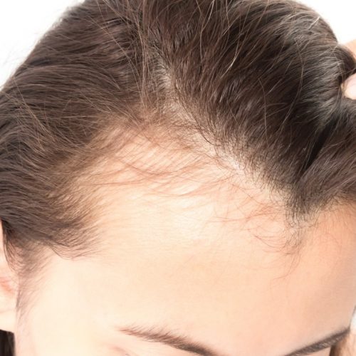 What Causes Hair to Fall Out Most Important Causes of Hair Loss That You Need Know