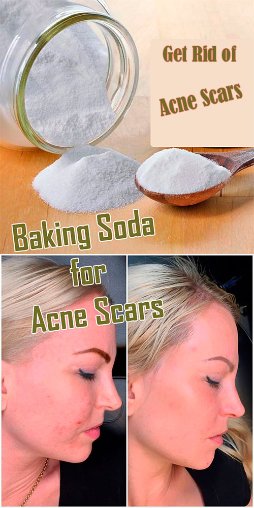 Baking soda for acne scars - get rid of acne scars