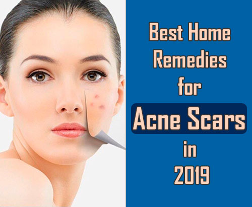 best treatment for acne scars 2019