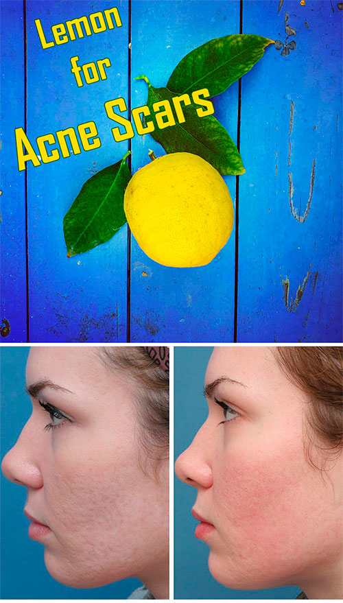 how long does lemon juice take to fade acne scars