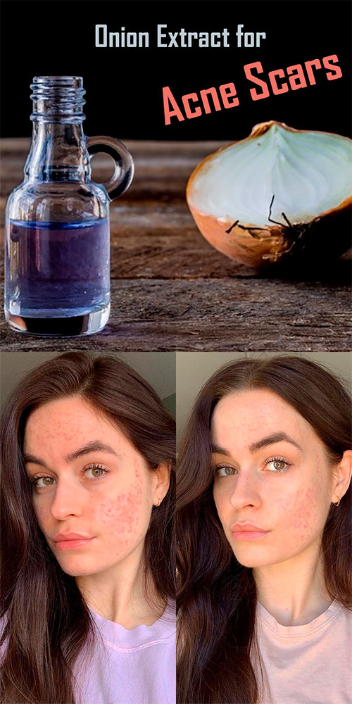 Onion extract for acne scars