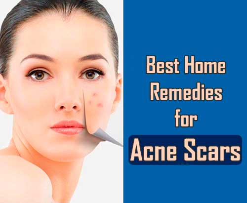 4 Best Home Remedies for Acne Scars