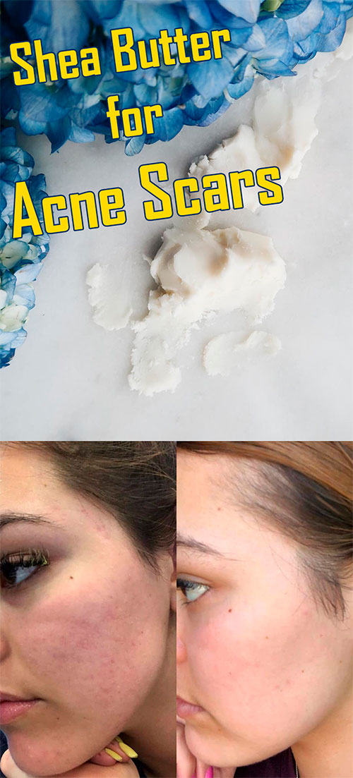 shea butter acne recipe