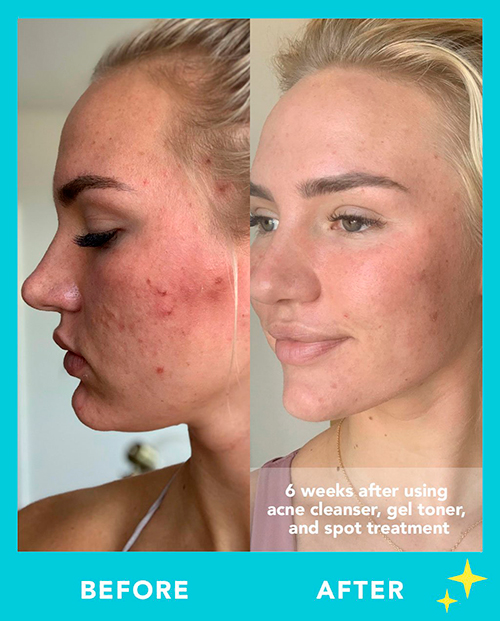 TULA Goodbye Breakouts Acne-Fighting Routine Results after 6 weeks!