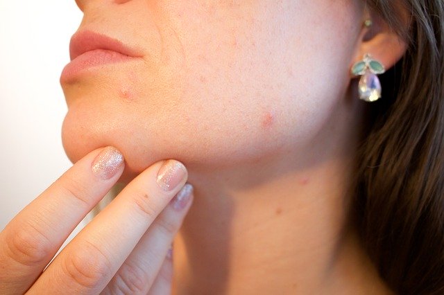 The Best Acne Spot Treatments Right Now