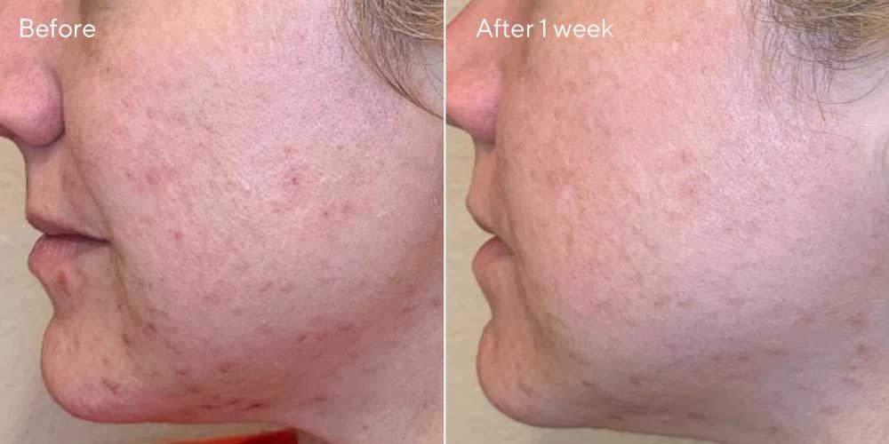 After and before using Murad Daily Clarifying Peel for a week to get smooth and clear skin
