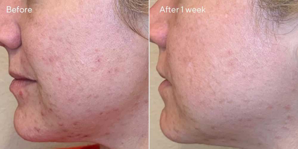 How to use Murad Daily Clarifying Peel After and before using Murad Daily Clarifying Peel for a week to get smooth and clear skin