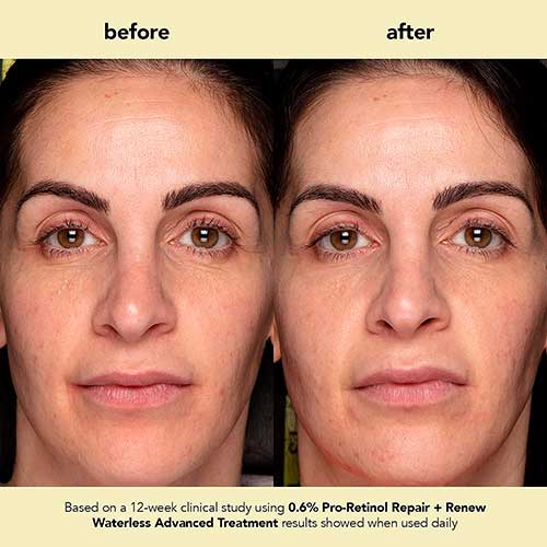 Before and After Boscia 0.6% Pro-Retinol Repair + Renew Waterless Advanced Treatment