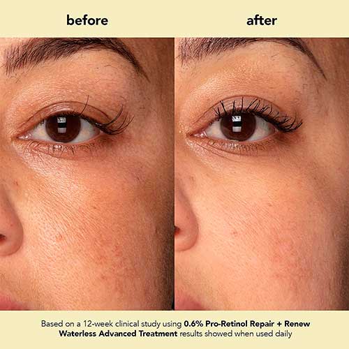 Before and After 12 weeks using Boscia Pro-Retinol Repair Renew Treatment