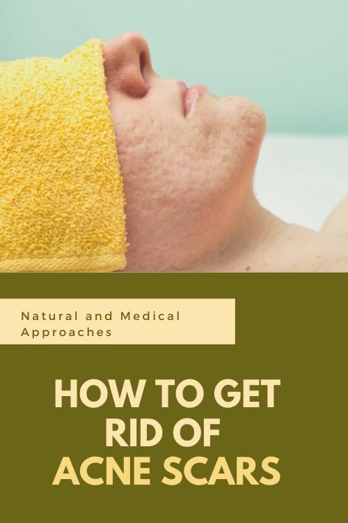 How to Get Rid of Acne Scars How to Get Rid of Acne Scars