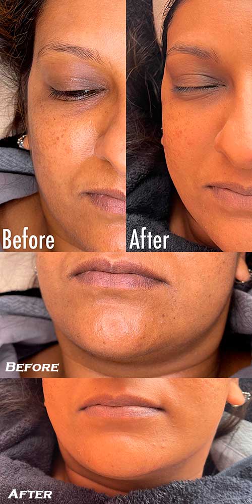 dermaplaning before and after - dermaplaning benefits