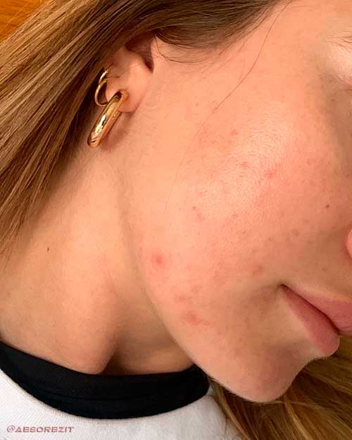 7 Ways to Get Rid of Pimples Naturally 7 Ways to Get Rid of Pimples Naturally - How to Get Rid of Pimples Naturally