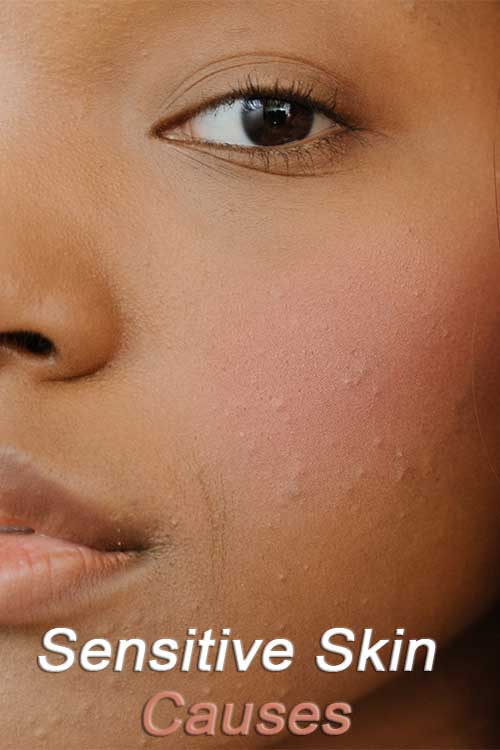 Sensitive skin can be caused by a variety of factors, including genetics, hormonal changes Sensitive skin can be caused by a variety of factors, including genetics, hormonal changes